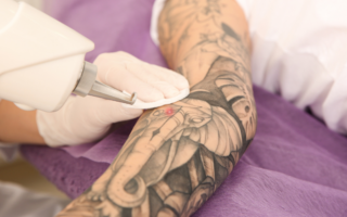 Retrait de tatouage