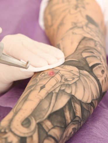 Retrait de tatouage