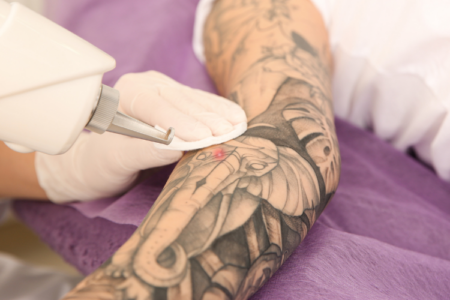 Retrait de tatouage