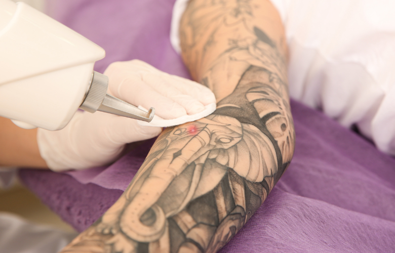 Retrait de tatouage